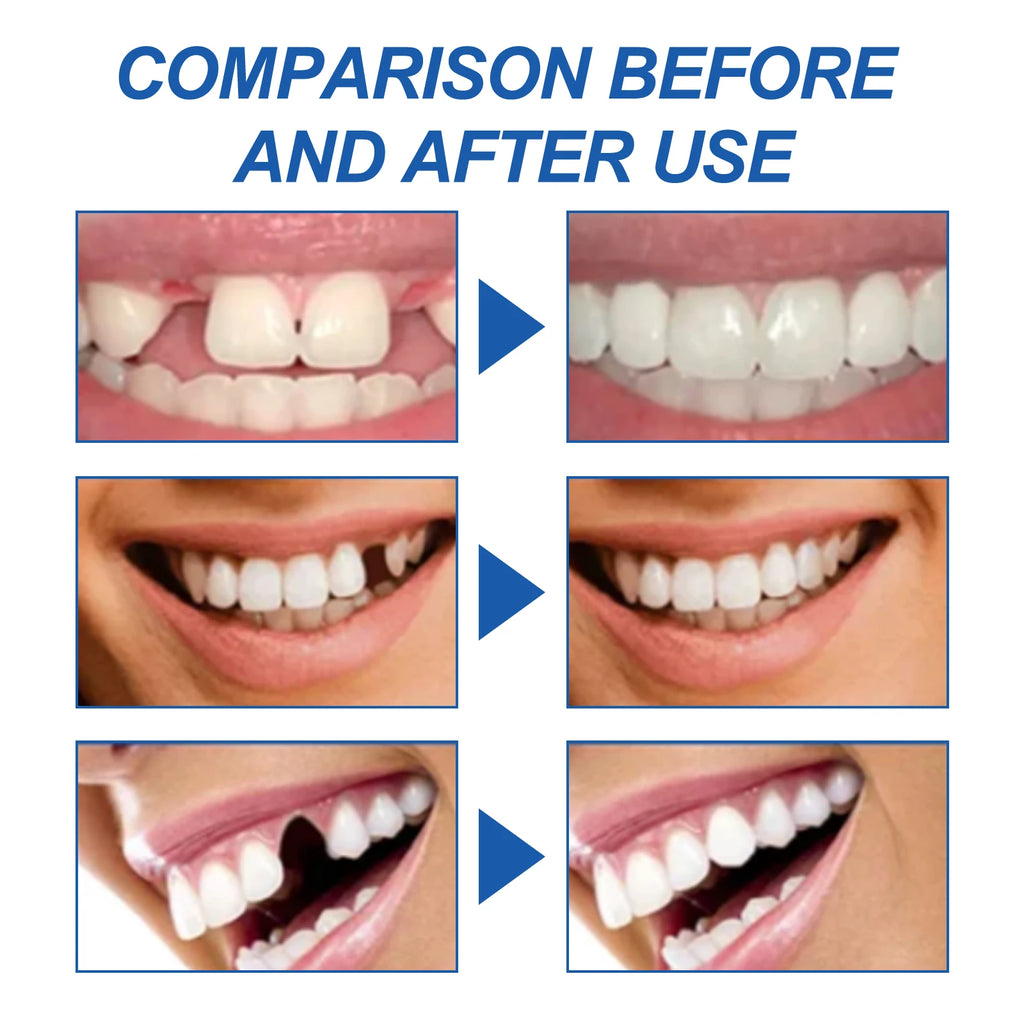Resin Temporary Tooth Repair Granules Teeth Gaps Missing Broken Tooth Filling Moldable Adhesive Dentures False Teeth Tools