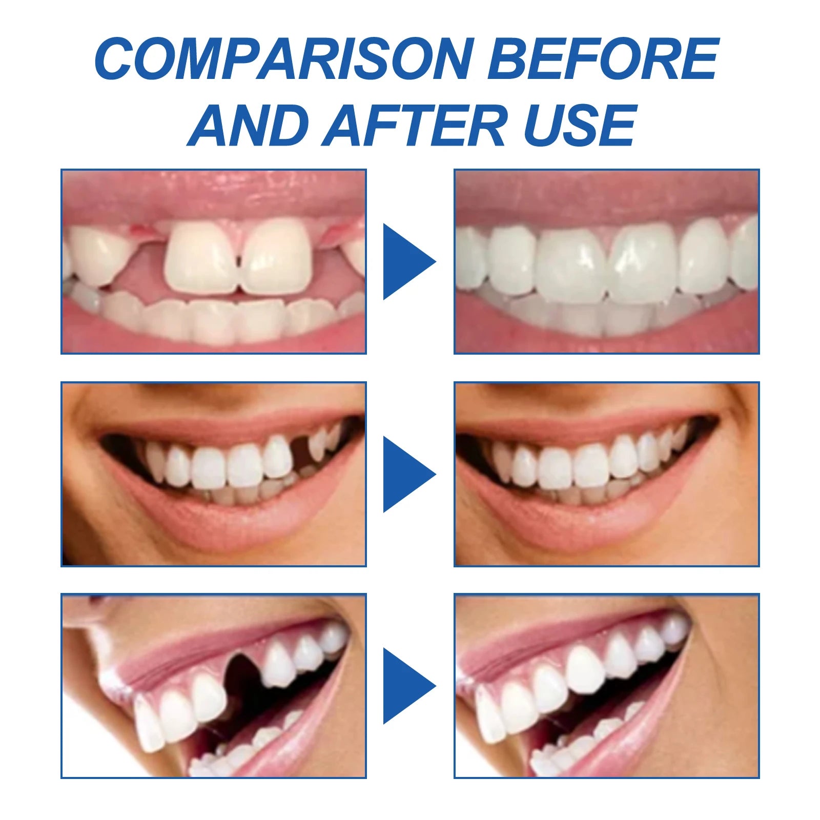 Resin Temporary Tooth Repair Granules Teeth Gaps Missing Broken Tooth Filling Moldable Adhesive Dentures False Teeth Tools